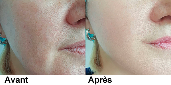 laser tattoo removal machine