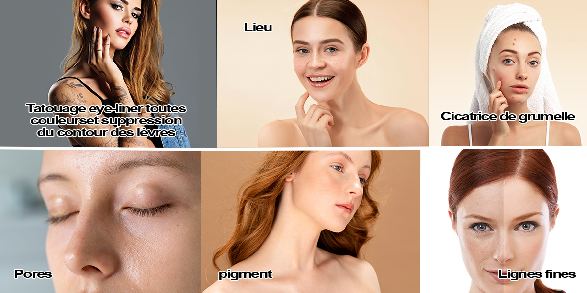 laser tattoo removal machine