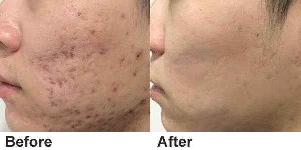 tattoo removal laser